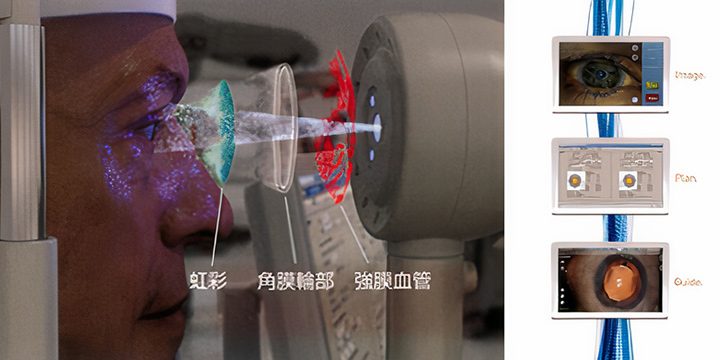有田眼科の白内障診療・検査のイメージ